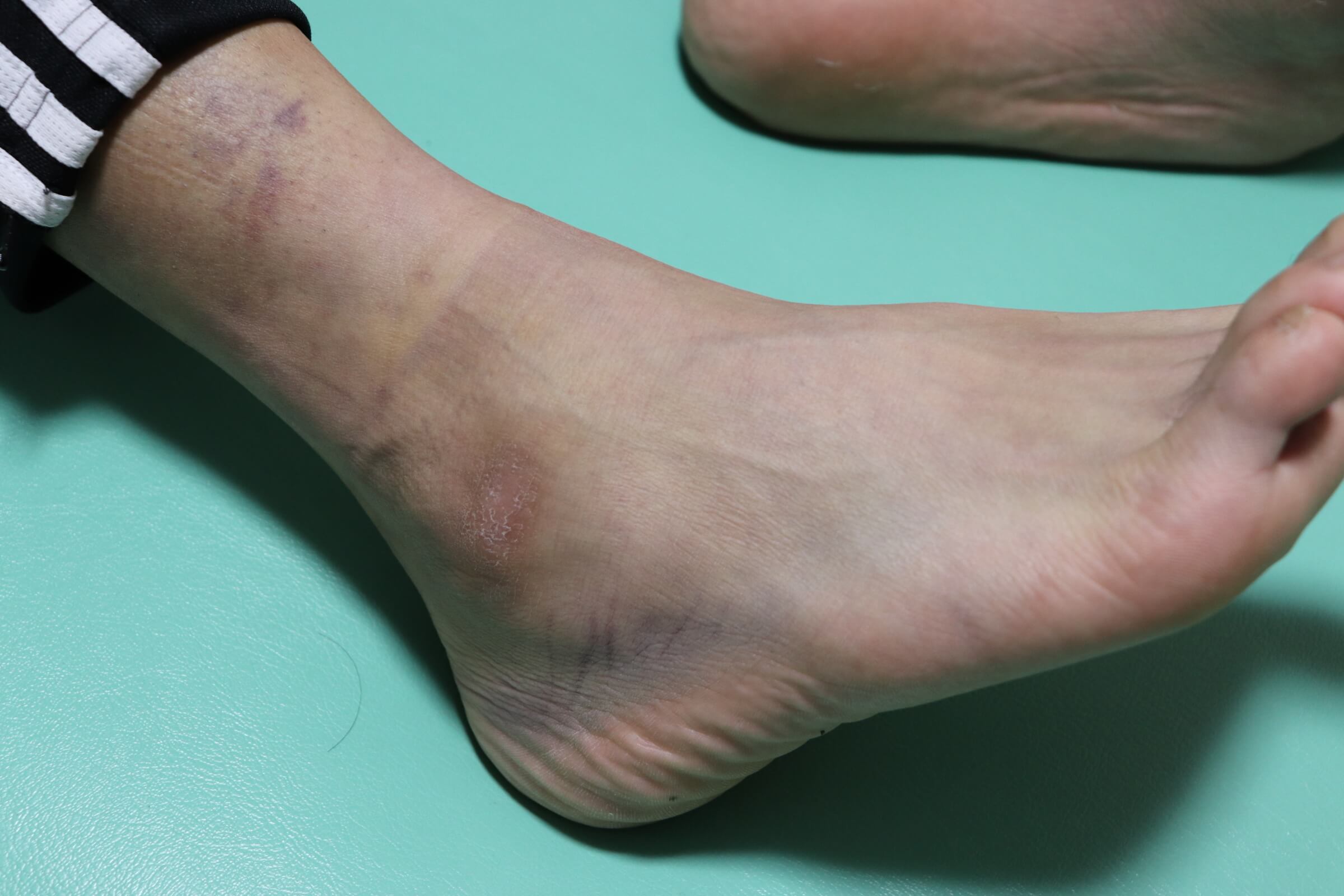 症例報告 右足関節の捻挫 高2 サッカー かはな治療院