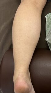 Read more about the article 【症例報告】ふくらはぎのむくみがひどくて、足がすごいだるいです 40代 女性 飲食業 むくみ 富士市